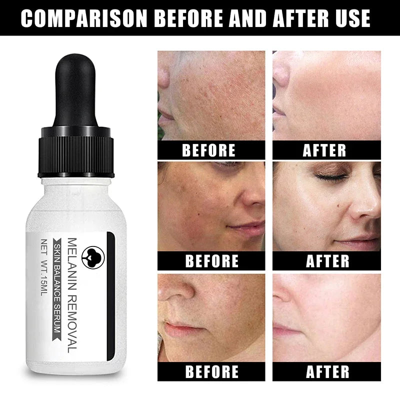 Niacinamide Serum Remove Dark Spots